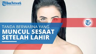 Tanda Lahir, Tanda Berwarna yang Muncul Tidak Lama setelah Seseorang Lahir