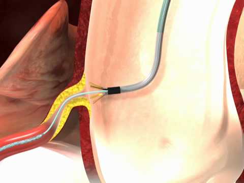 Ostial PRO® Stent Positioning System 3D Animated Video