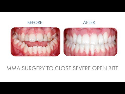 Mary Nordhal (patient) - MMA Surgery to Address Severe Open Bite