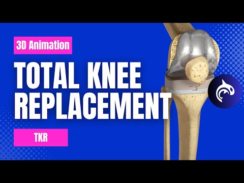 Total Knee Replacement (TKR): Condition, Treatment, and Surgery - 3D Animation