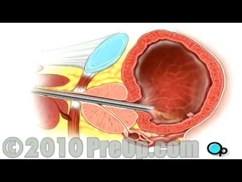 Cystoscopy Male via Penis PreOp® Patient Education Feature