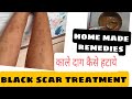 black marks on legs/ mosquito scars on legs treatment