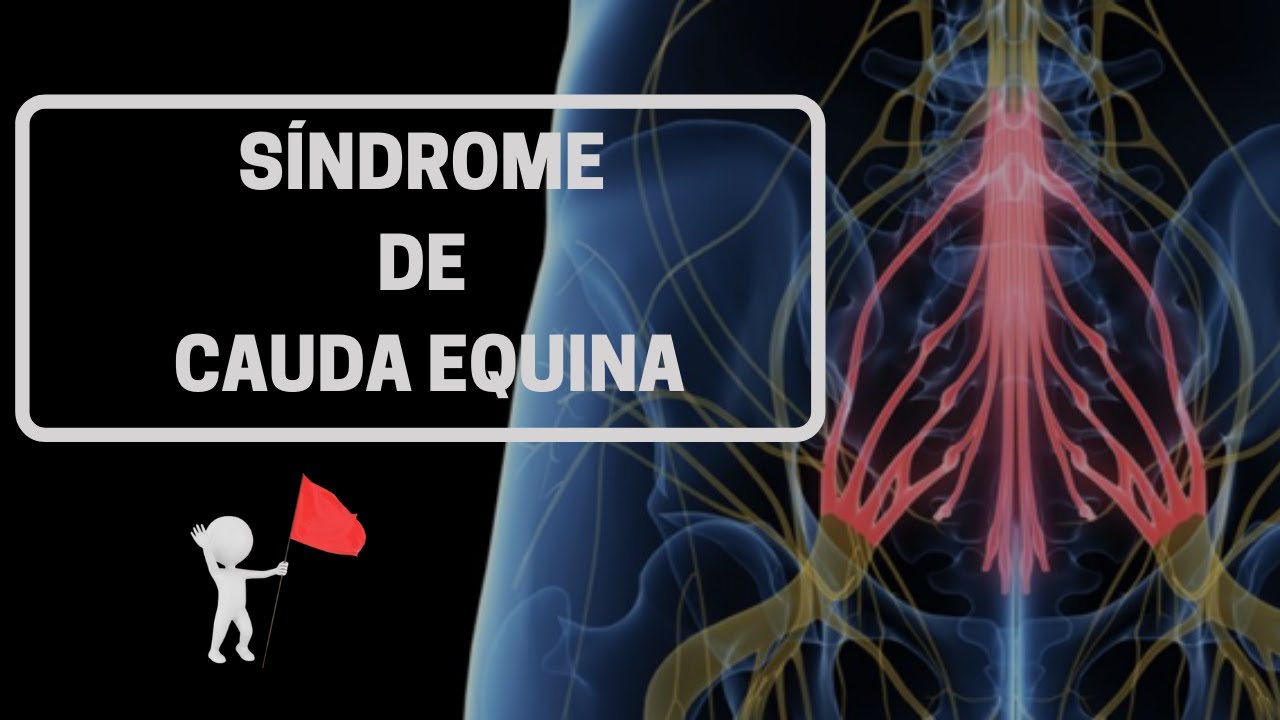 Watch SÍNDROME DE CAUDA EQUINA Now SÍNDROME DE CAUDA EQUINA