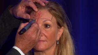 Injectors Anatomy of the Forehead