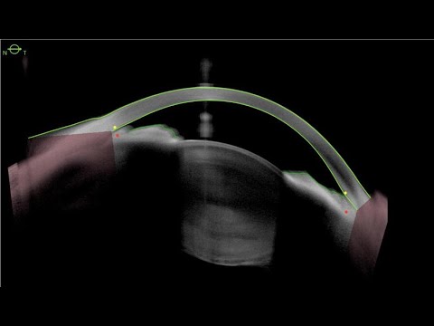 Angle Closure In Pediatric Patient: Lensectomy, CTR, Goniosynechialysis, Goniotomy & iStents