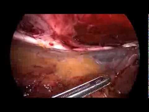 Laparoscopic repair of parastomal and incisional hernia: modified Sugarbaker technique__Dr. JM Park