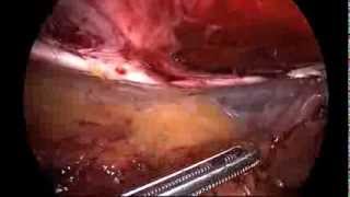 Laparoscopic repair of parastomal and incisional hernia: modified Sugarbaker technique__Dr. JM Park