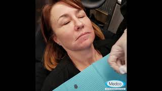 How to mix fillers and RPRF at the same time for facial esthetics