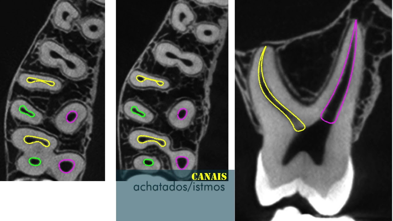 Anatomia e abertura coronária do Molar Superior
