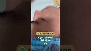 Cyst removal surgery in Delhi | Cyst Removal Procedure | SkinQure