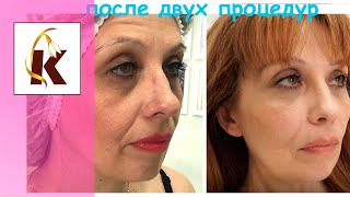 Почему в носогубках не держится филлер