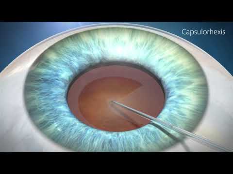 Cataract Surgery Animation