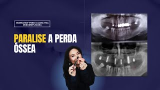 Protocolo para Paralisar a Perda Óssea Definitivamente