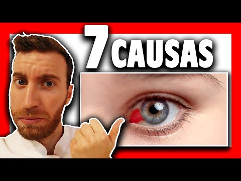 ♦️ ¿Por qué sale SANGRE en el OJO? ¿Qué es?