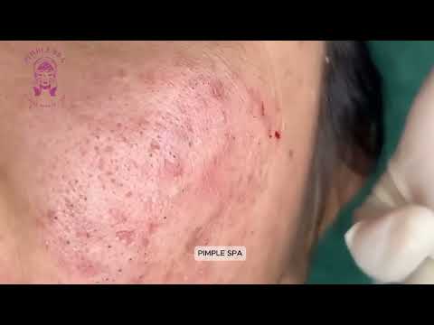 Blackhead Removal The Most Satisfying Extraction |PIMPLE SPA