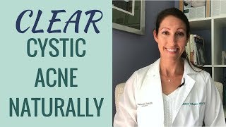 How to Treat and Cure Cystic Acne Naturally | Clinically Proven RESULTS to Get Rid of Acne Fast!!