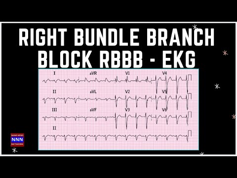 Right Bundle Branch Block BLOCK | RBBB  | BY NIK NIKAM MD