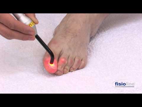 Fisioline Laser Lumix C.P.S. Podiatry: Trattamento onicomicosi