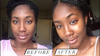 USING DOXYCYCLINE FOR ACNE| 1 MONTH UPDATE