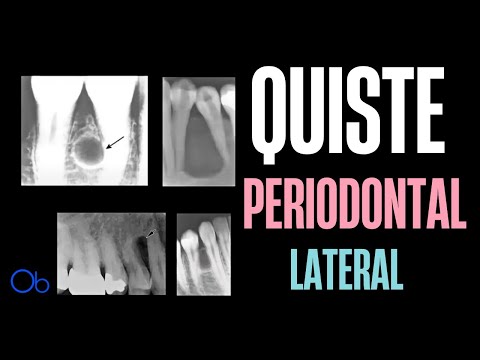Quiste Periodontal Lateral