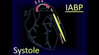 Intra-aortic Balloon Pump Aortic Pressure Curve