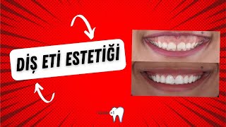 DİŞ ETİ ESTETİĞİ NASIL YAPILIR ? BİLMENİZ GEREKENLER
