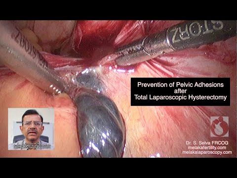 Prevención de adherencias pélvicas después de una histerectomía laparoscópica total
