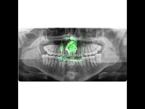 Extracción de cordales sin dolor Barranquilla - Maxilofacial Fragozo