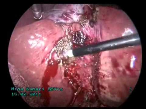 Argon Plasma Coagulator - The Non Contact Modality for Hemostasis & Devitalization