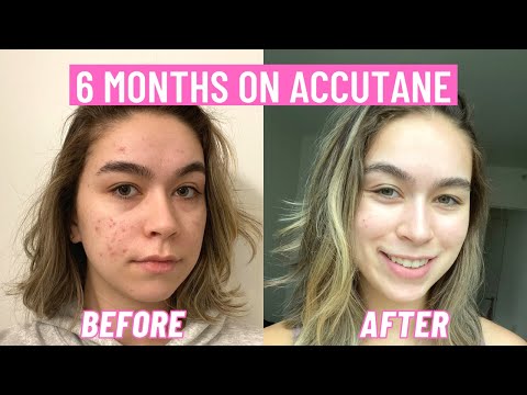 My six month Accutane journey and how I cleared my skin