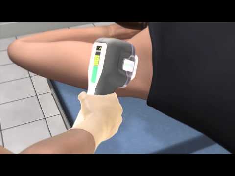 miraDry Clínica ORM - Nova tratamento para o suor excessivo (hiperidrose axilar)