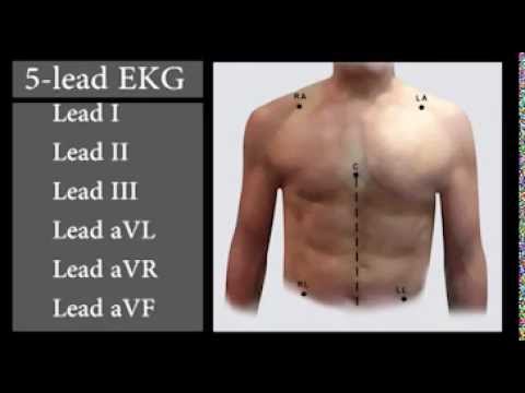 EKG Interpretation and Response SERIES: Reading an EKG
