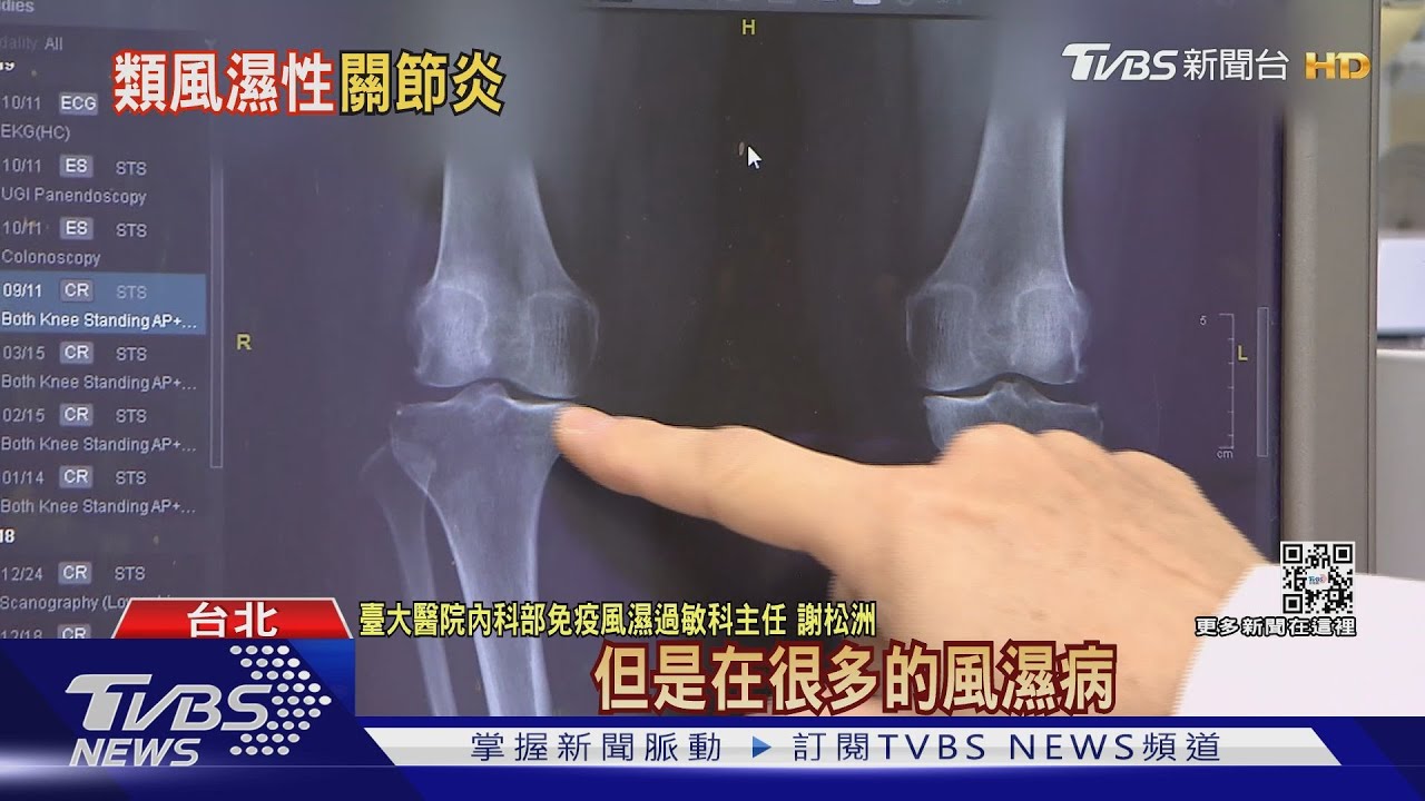 罹患這疾病...導致肺纖維化、關節受傷害! 醫:這部位疼痛注意!
