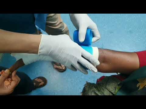 Fracture Lower end Radius | Closed reduction | Fiberglass plastering | Adamya Hosp videos