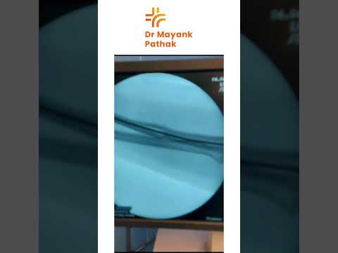 Monteggia Fracture Dislocation | Dr. mayank Pathak
