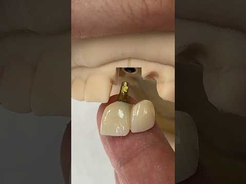 2-Unit Monet Pure Zirconia Bridge @EnvisiontecMain #envisiontec #dental #teeth #lsk121shorts