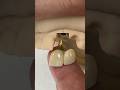 2 Unit Monet Pure Zirconia Bridge EnvisiontecMain Envisiontec Dental Teeth Lsk121shorts