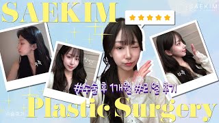 성형 후 일상에 어떤 변화가 있었을까요?! 새김성형외과 1개월 차 고객님의 리얼 후기!｜[눈, 코, 윤곽] 리얼후기(2)