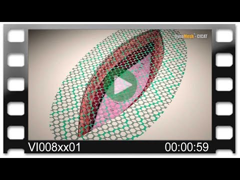 DynaMesh®-CICAT - Animation: Retromuscular Alloplasty - Incisional Hernia Repair