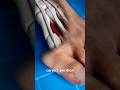 Bunion Correction Explained Doctor Reacts