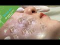 (Acne Treatment for Ha Part 3) - Make Your Day Relaxing with Windy Spa 6#218 (Acne Treatment for Ha Part 3) - Make Your Day Relaxing with Windy Spa 6#218