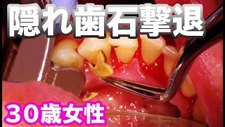 [問卦] 日本人的牙結石為啥那摸多