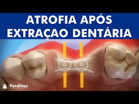Atrofia após a extração do dente ©
