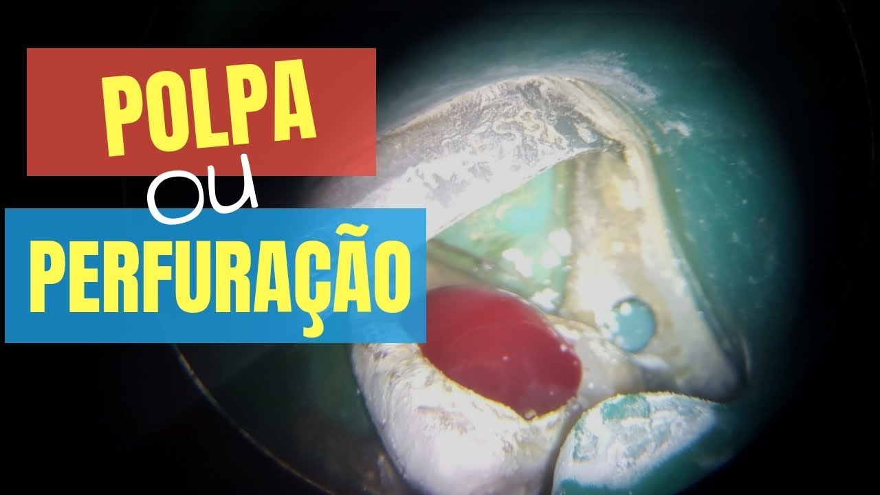 SANGRAMENTO ABUNDANTE NA ABERTURA: POLPA OU PERFURAÇÃO? - QUICK TIP ENDOLOVERS