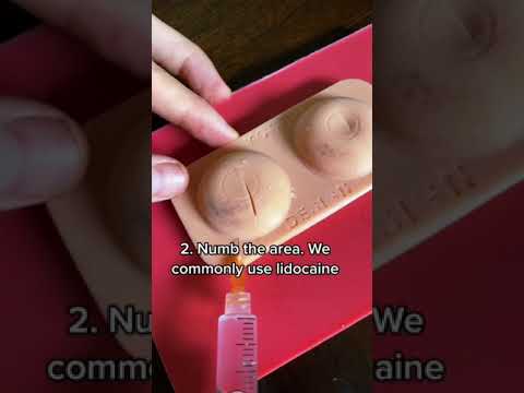 Abscess Drainage