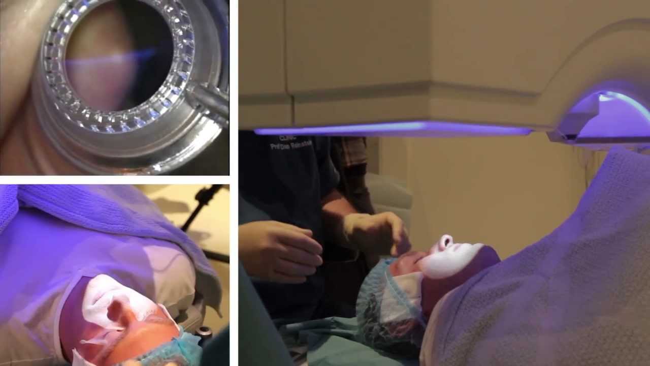 LASIK: A Live Case (Professor Dan Reinstein, London Vision Clinic) — LASIK & PRK (Reinstein Course)
