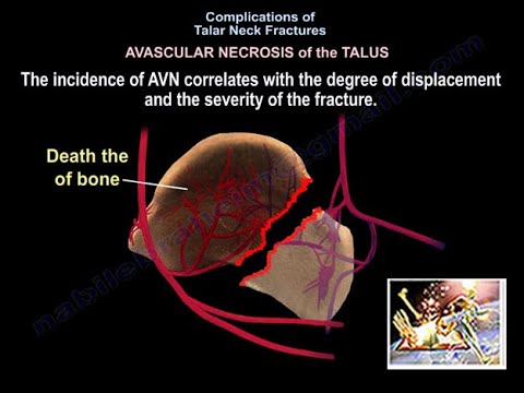 Complications Of Talar Neck Fractures - Everything You Need To Know - Dr. Nabil Ebraheim