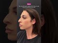 Leila Hormozi 1 week after Designer Rhinoplasty®