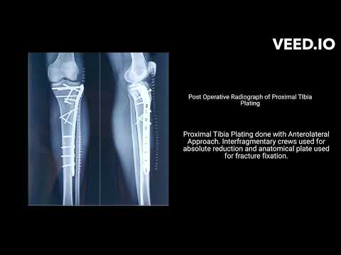 Proximal Tibia Plating - Dr Sunny Dole