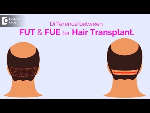 Difference between FUT and FUE technique of hair transplant - Dr. Suvina Attavar